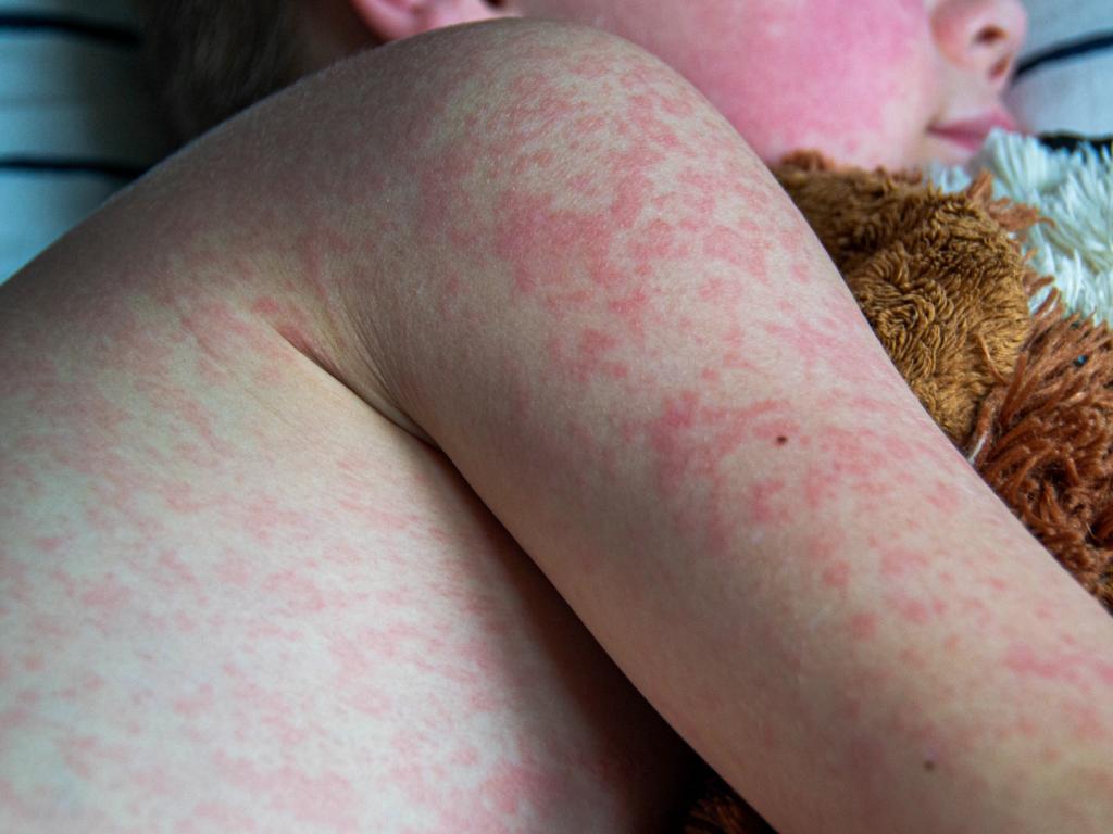 Casos de sarampo são confirmados em Uberlândia; secretária de...